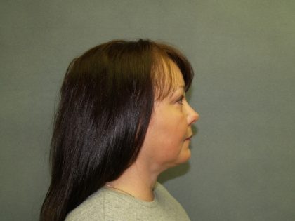 Chin Lipo Before & After Patient #482