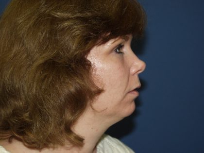 Chin Lipo Before & After Patient #490