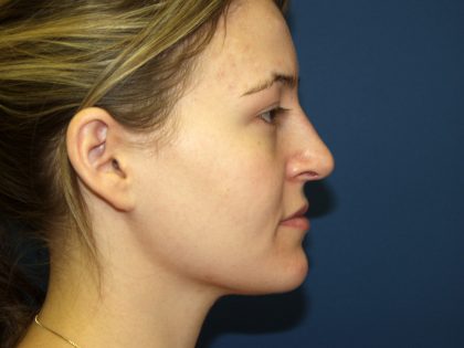 Nose Surgery Before & After Patient #738