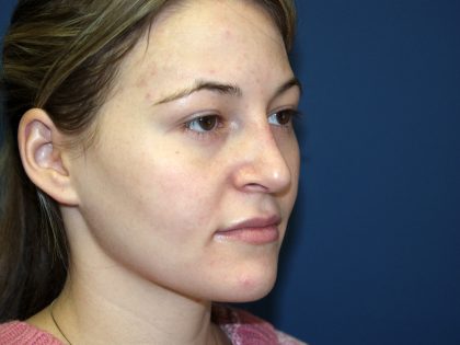 Nose Surgery Before & After Patient #738