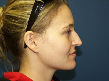 Nose Surgery Before & After Patient #738