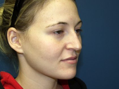 Nose Surgery Before & After Patient #738