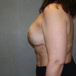 Breast Reconstruction Before & After Patient #1906