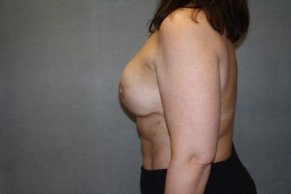 Breast Reconstruction Before & After Patient #1906