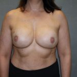 Breast Reconstruction Before & After Patient #1906