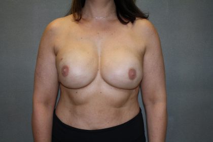 Breast Reconstruction Before & After Patient #1906