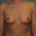 Breast Augmentation Before & After Patient #2675