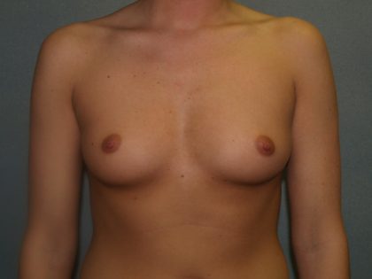 Breast Augmentation Before & After Patient #2675