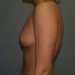 Breast Augmentation Before & After Patient #2675