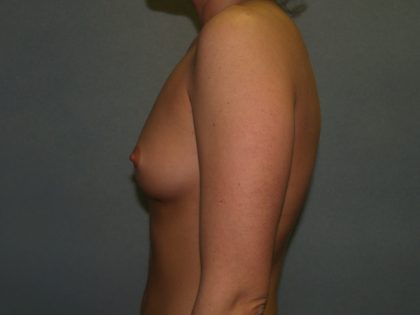 Breast Augmentation Before & After Patient #2675