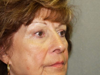 Nose Surgery Before & After Patient #804