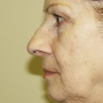 Nose Surgery Before & After Patient #804