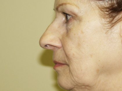 Nose Surgery Before & After Patient #804