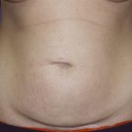 Tummy Tuck Before & After Patient #2426