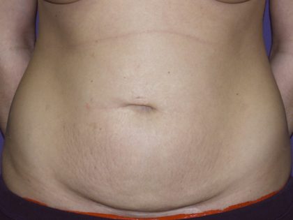 Tummy Tuck Before & After Patient #2426