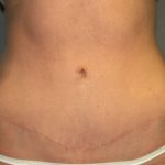 Tummy Tuck Before & After Patient #2426