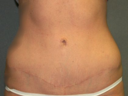 Tummy Tuck Before & After Patient #2426