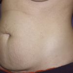 Tummy Tuck Before & After Patient #2426