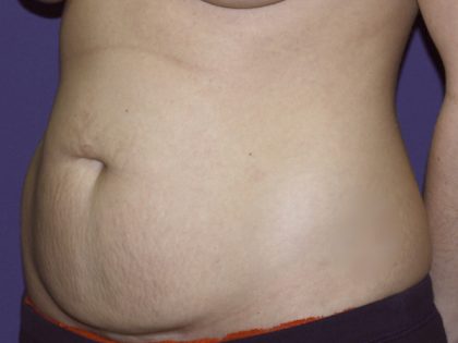 Tummy Tuck Before & After Patient #2426