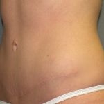 Tummy Tuck Before & After Patient #2426