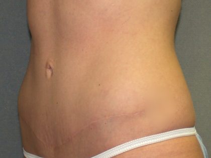 Tummy Tuck Before & After Patient #2426