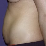Tummy Tuck Before & After Patient #2426