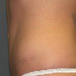 Tummy Tuck Before & After Patient #2426