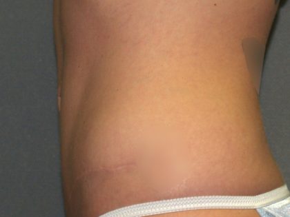 Tummy Tuck Before & After Patient #2426