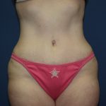 Tummy Tuck Before & After Patient #2410