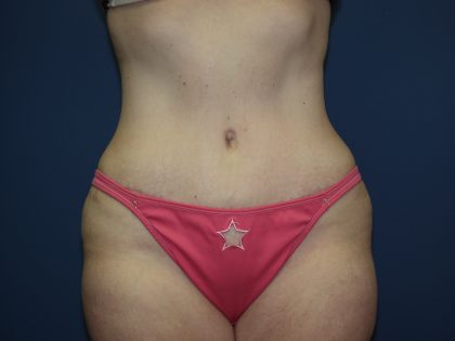 Tummy Tuck Before & After Patient #2410