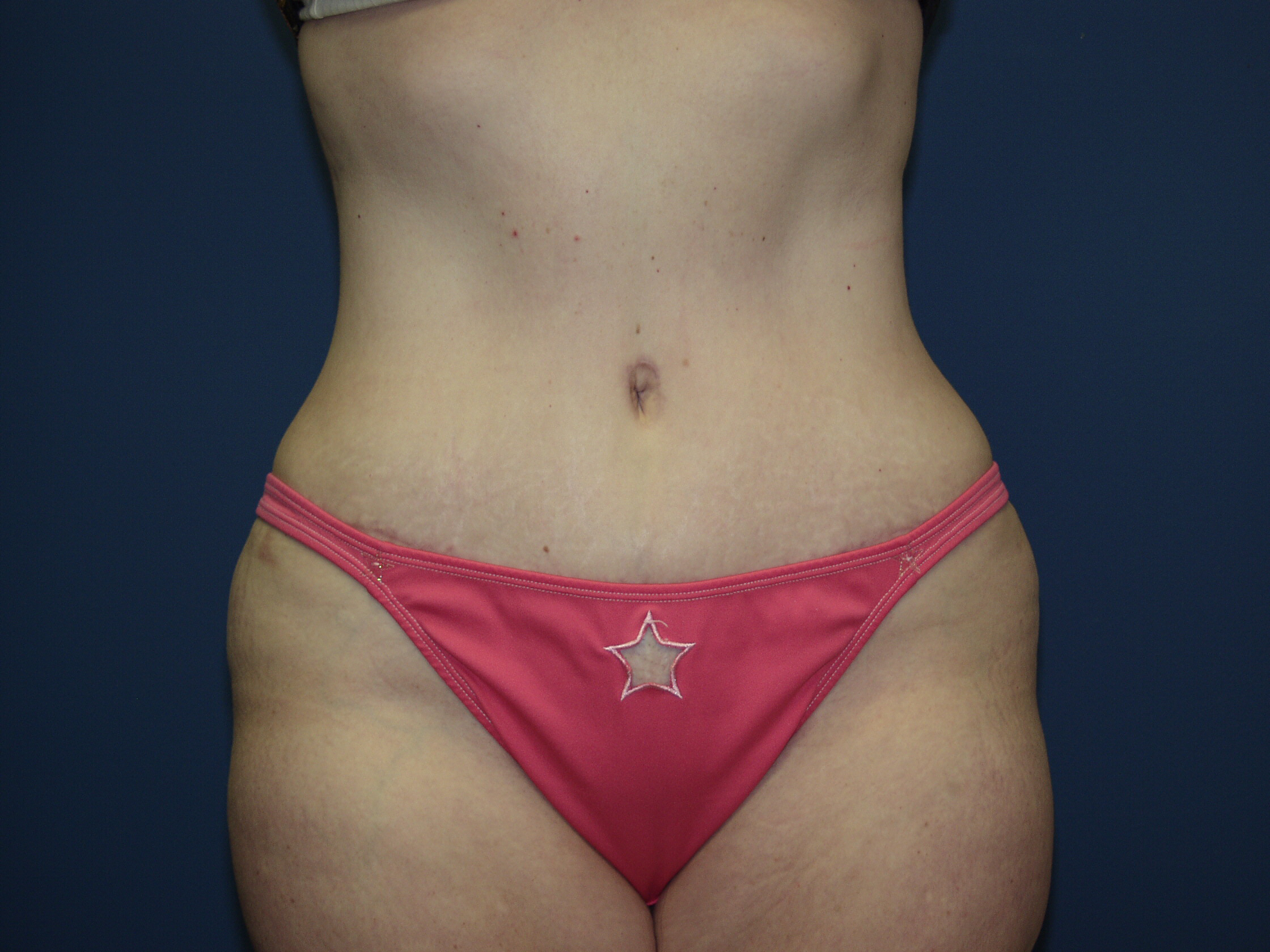 Tummy Tuck Before & After Patient #2410
