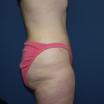 Tummy Tuck Before & After Patient #2410