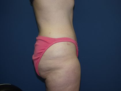 Tummy Tuck Before & After Patient #2410