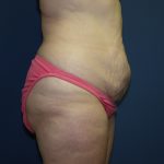 Tummy Tuck Before & After Patient #2410