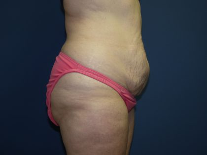 Tummy Tuck Before & After Patient #2410