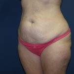 Tummy Tuck Before & After Patient #2410