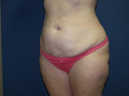 Tummy Tuck Before & After Patient #2410