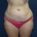 Tummy Tuck Before & After Patient #2410