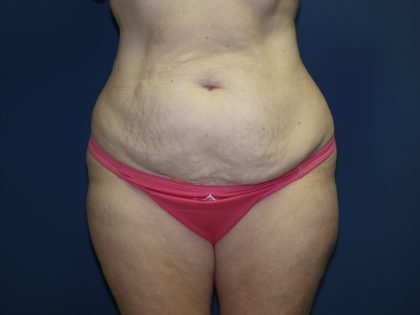 Tummy Tuck Before & After Patient #2410