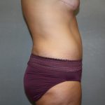 Tummy Tuck Before & After Patient #2353