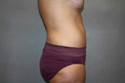 Tummy Tuck Before & After Patient #2353