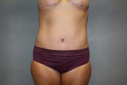 Tummy Tuck Before & After Patient #2353