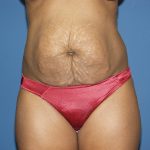 Tummy Tuck Before & After Patient #2060