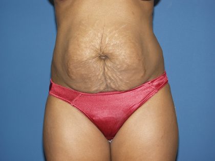 Tummy Tuck Before & After Patient #2060