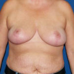 Breast Reduction Before & After Patient #3510