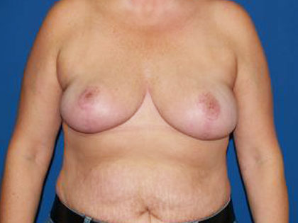 Breast Reduction Before & After Patient #3510