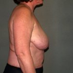 Breast Reconstruction Before & After Patient #1739