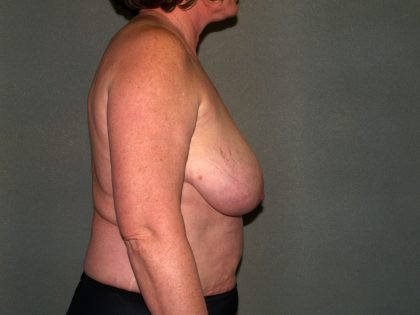 Breast Reconstruction Before & After Patient #1739