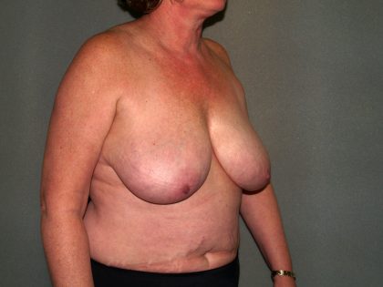 Breast Reconstruction Before & After Patient #1739