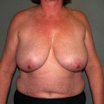 Breast Reconstruction Before & After Patient #1739